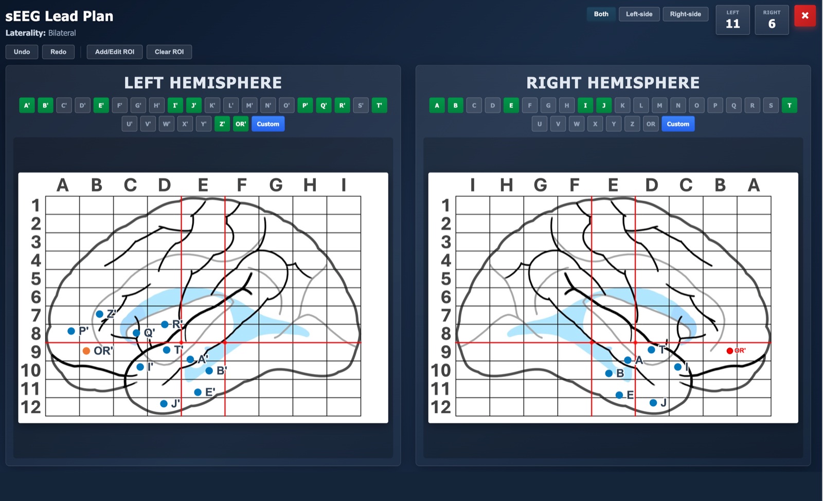 sEEGplan bilateral hemisphere planning view with leads on both sides