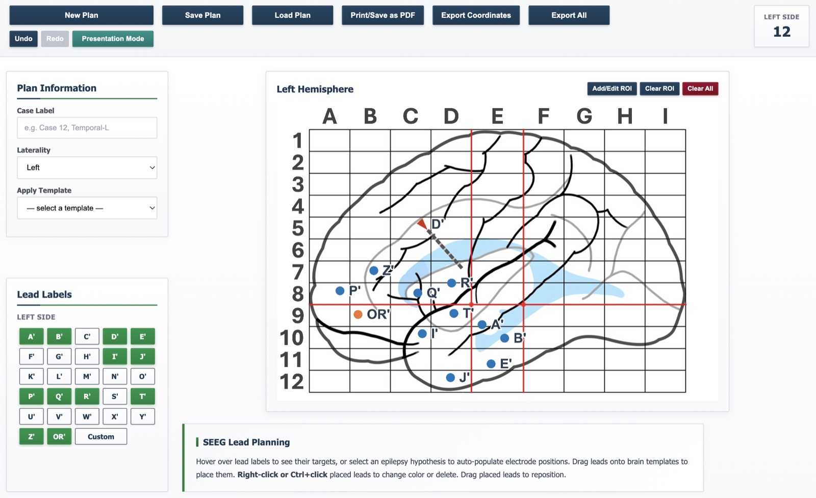 sEEGplan single-hemisphere planning view with placed sEEG leads